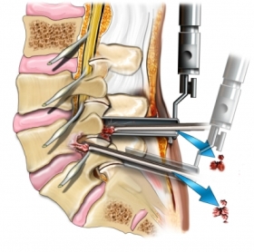 laparoscopic discectomy small